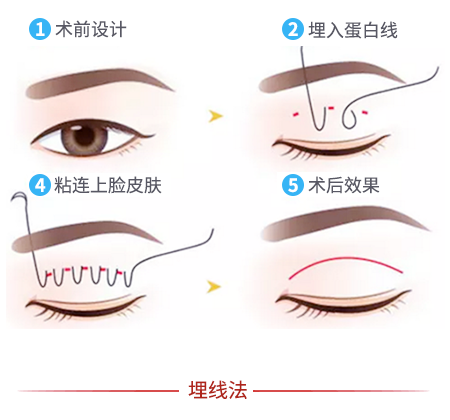 高度近视文章推荐